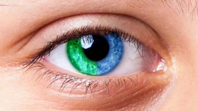 تغاير اللون الجزئي - sectoral heterochromia