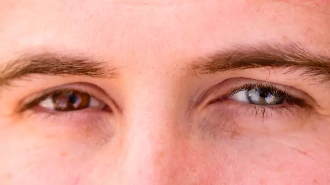 تغاير اللون الكامل - congenital heterochromia