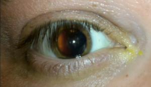 أسباب وأعراض ارتفاع ضغط العين