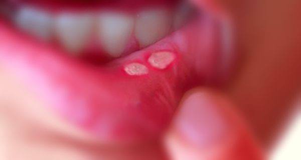 علاجات منزلية لتقرحات الفم