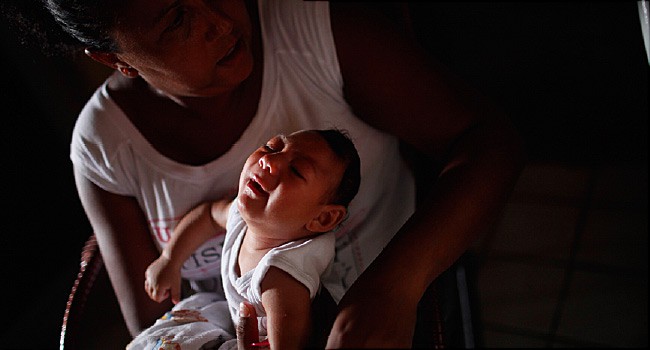 فيروس زيكا ولادة أطفال برأس صغير
