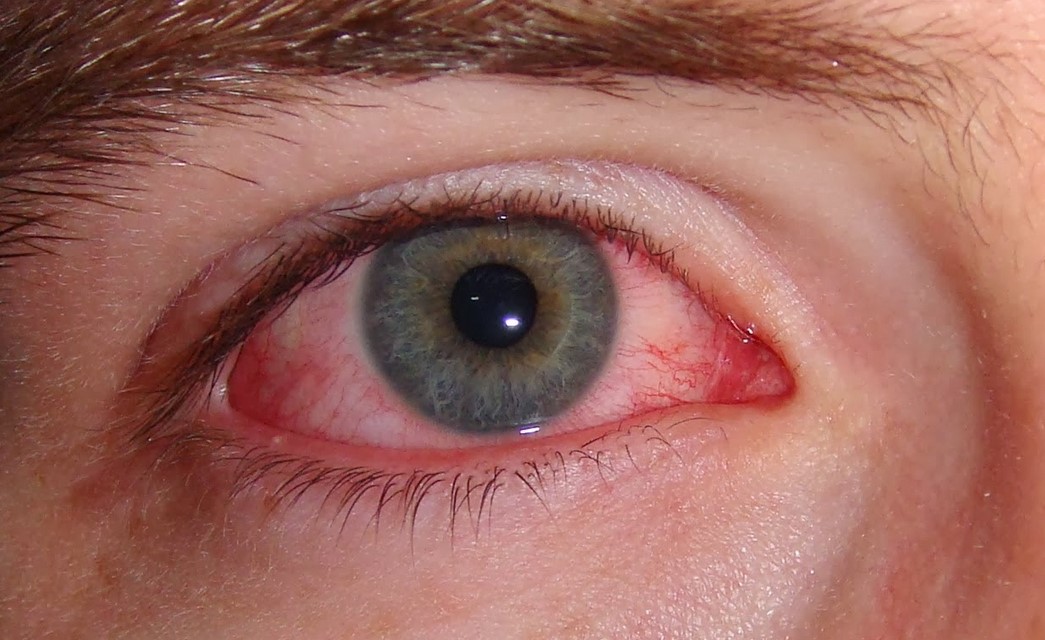 الأسباب المؤدية للإصابة بالرمد الربيعي أو حساسية العين في الربيع