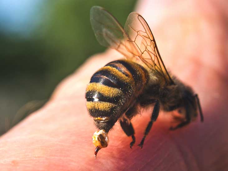 العلاج بلسعة النحل