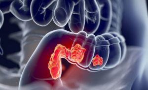 أعراض سرطان القولون عند النساء
