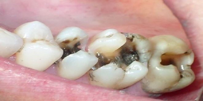 علاج تسوس الأسنان بالأعشاب