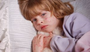حساسية الجلد عند الأطفال من الأكل