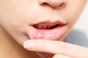 علاج قلاع الفم