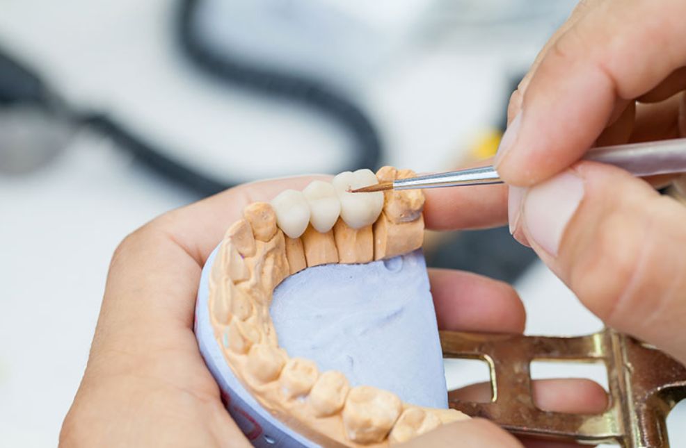 كيف يتم الاختيار بين أنواع تلبيس الأسنان ؟
