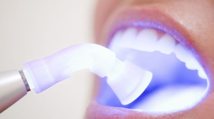 آثار تبييض الأسنان