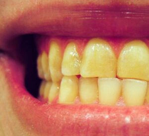أسباب اصفرار الأسنان الـ 20 وكيف عليك التعامل مع كل منها