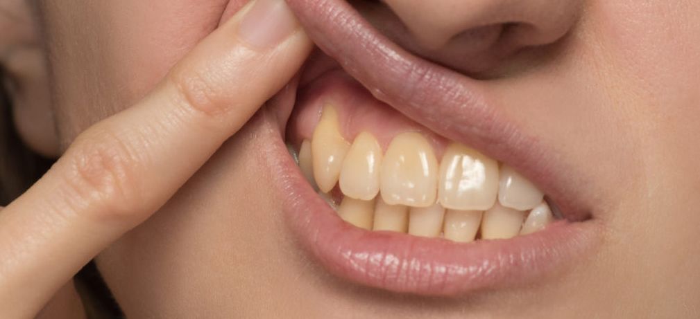 أسباب اصفرار الأسنان