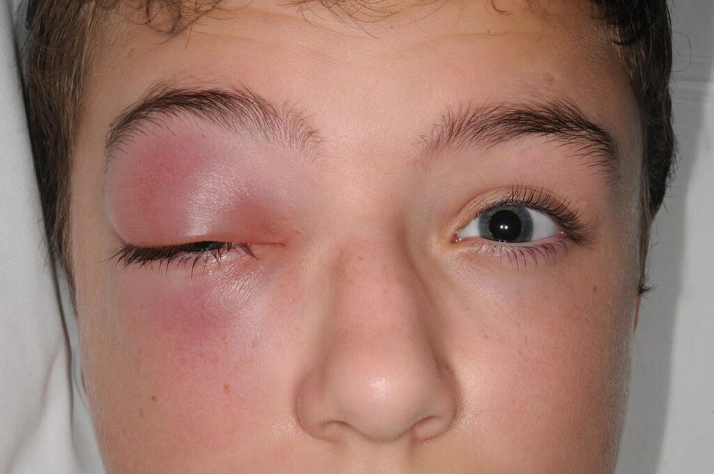 أعراض احمرار العين عند الأطفال