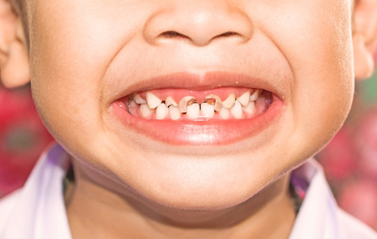 تخفيف ألم تسوس الأسنان عند الأطفال