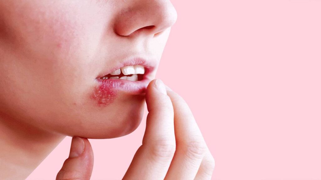 علاج تقرحات الفم