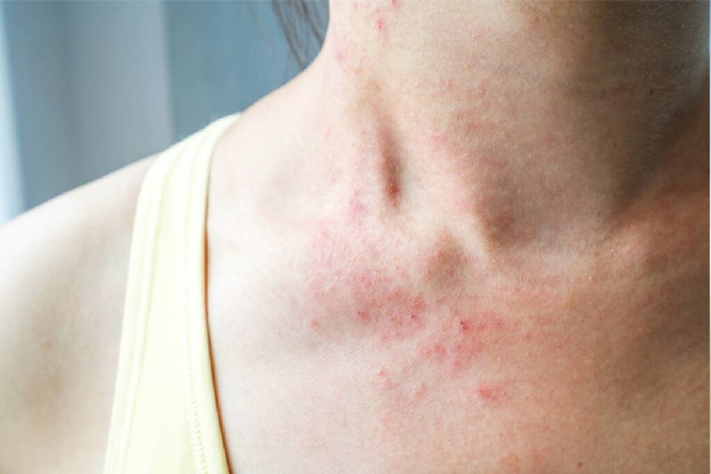 أعراض التهاب الجلد التماسي