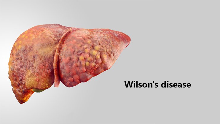 مرض ويلسون الوراثي
