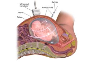 فحص السائل الأمنيوسي (بزل السلى) Amniocentesis