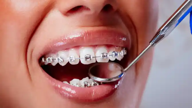 نصائح لتقويم الأسنان - أهم 20 نصيحة للحفاظ على الأسنان بعد تركيب التقويم
